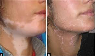 Topical steroid therapy for vitiligo